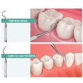 Bộ dụng cụ 3 món lấy cao răng, vệ sinh răng tại nhà
